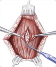 strumectomy