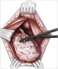 strumectomy 2