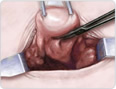 abdominal hysterectomy