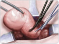 abdominal hysterectomy 2