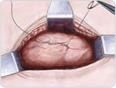 abdominal hysterectomy 3