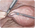 laparoscopic hysterectomy 2