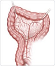 procedures on the colon