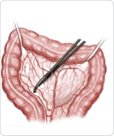 procedures on the colon 2