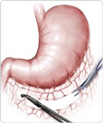 procedures on the colon 4