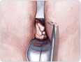 vaginal hysterectomy 3